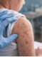 Measles alert public health warning NSW